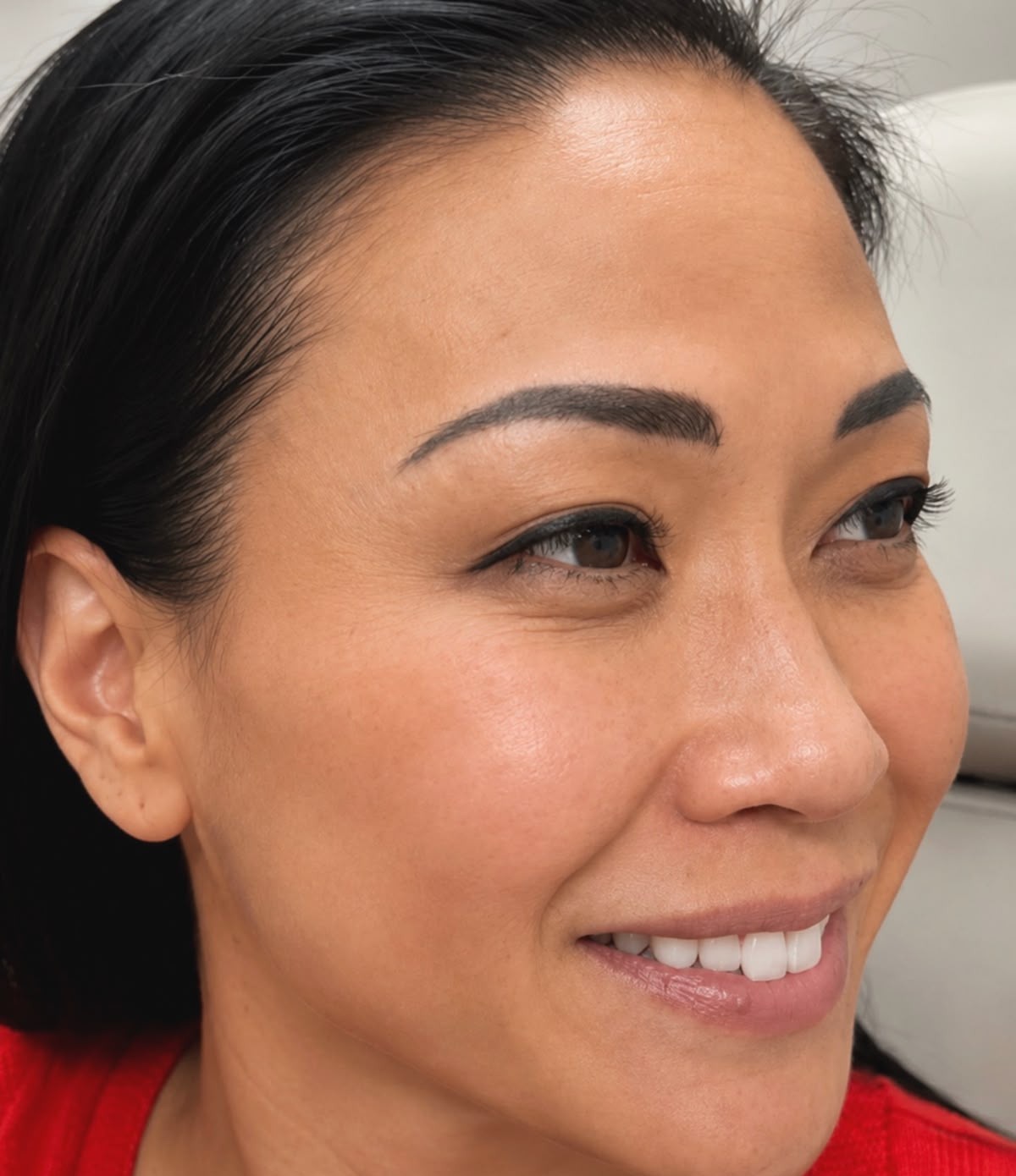 Real Xeomin result, Mankato MN